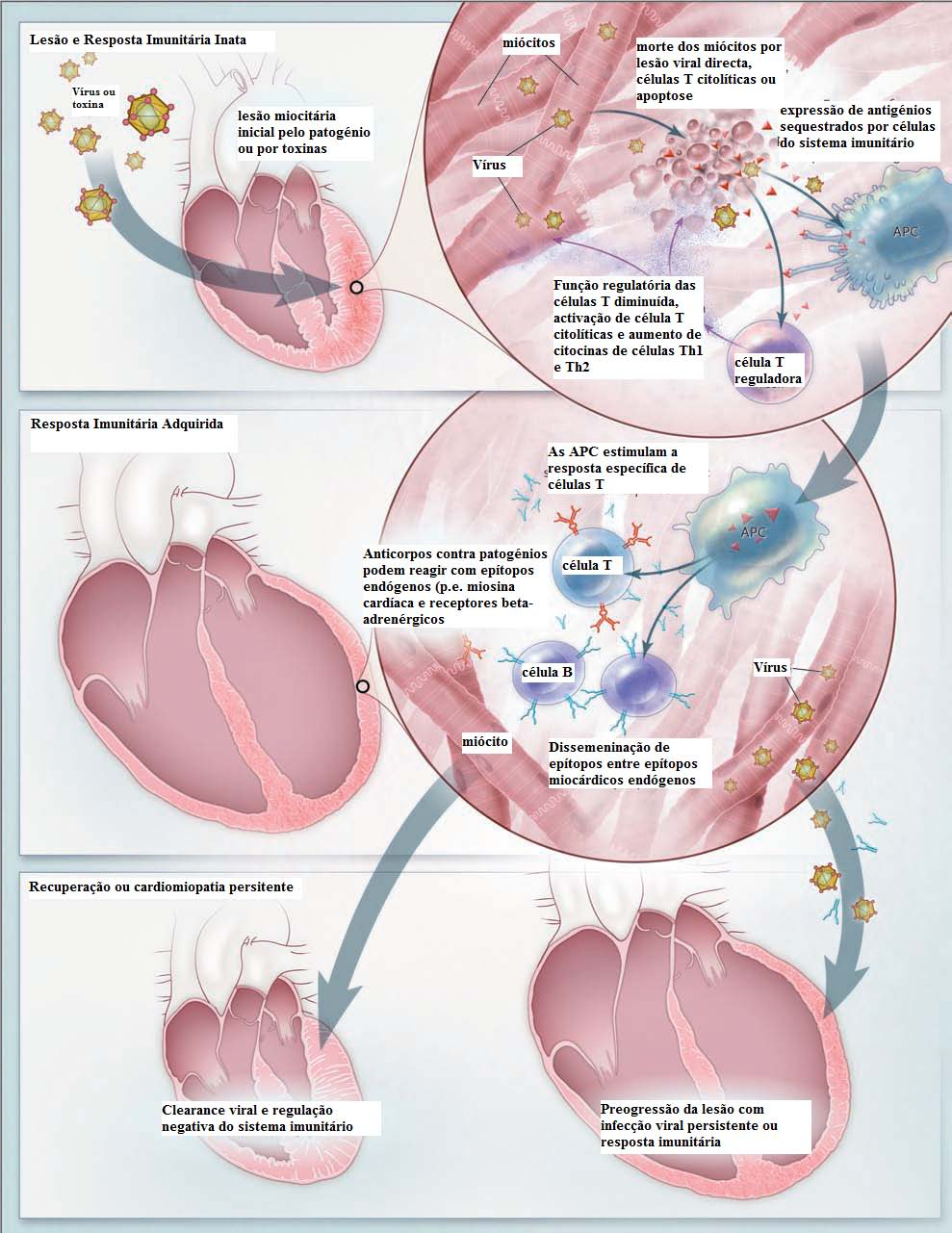 Figura 1 - Fisiopatologia da Miocardite (Cooper, LT: Myocarditis. N Engl J Med 2009;360:1526-38.) imunitária.