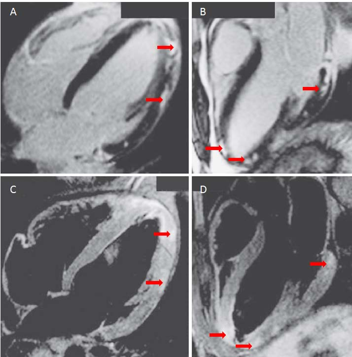 Figura 3 Imagem de Ressonância Magnética com Contraste do coração de um doente de 24 anos com miocardite aguda.