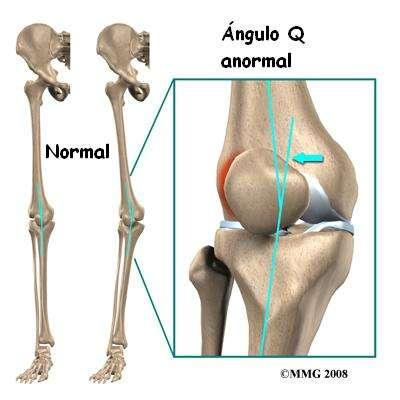 17 tubérculo da tíbia se inserindo no meio da patela. O ângulo Q descreve o alinhamento normal da patela, sendo este, de 15 em mulheres e 10º em homens 23. Figura 1.