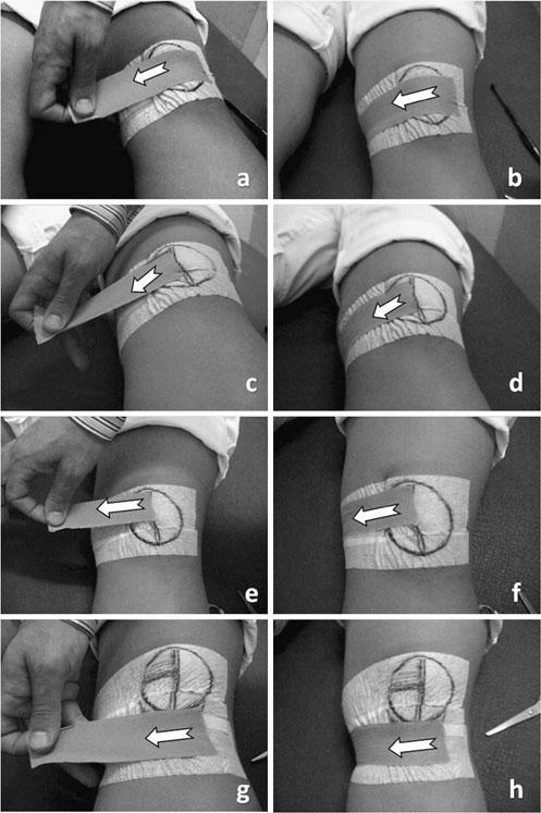 27 2.4.1.3 Aplicação 3 McConnell 15 descreve quatro técnicas principais para a aplicação da bandagem na síndrome patelofemoral, sendo elas: para correção de um deslizamento lateral (figura 12.