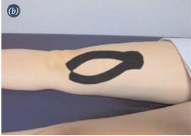 46 utilizou Kinesio Taping para aumentar o tônus da cabeça medial do músculo quadríceps da coxa no membro inferior dominante.