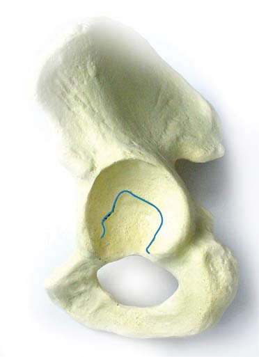 Para se obter uma boa área de extensão da cavidade acetabular e diáfise do fêmur, é importante que neste exame se exclua as cristas ilíacas.
