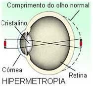 Hipermetropia: É o contrario da miopia.