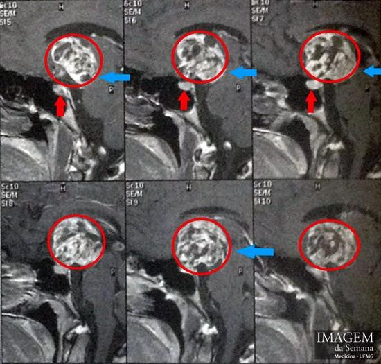 Imagem 4: Detalhe de Ressonância Nuclear Magnética (RM) de crânio, corte sagital, ponderada em T1, após administração de contraste (Gadolínio).