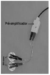 Este procedimento foi realizado utilizando-se um aparelho de eletroestimulação modelo Neurodyn, marca