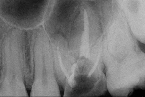Lesão de furca com barreira de CIV e RC INTRODUÇÃO Dentes com envolvimento de furca são os mais freqüentemente perdidos após tratamento periodontal, em decorrência da continuidade da progressão da