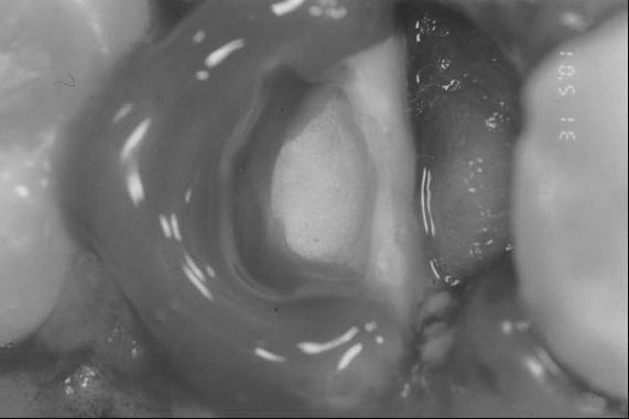 pelo fabricante. A resina composta foi inserida até o nível do equador dental, permanecendo como uma restauração provisória (Figuras 9 e 10). Figura 5.