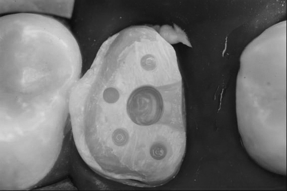Novas camadas de resina foram adicionadas sobre as fitas, e o dente 26 foi reconstruído através da inserção em múltiplos