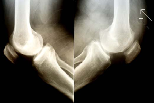 Paciente do sexo masculino, 57 anos, motorista, refere dor e edema progressivo com perda da mobilidade em joelho esquerdo há 8 anos.