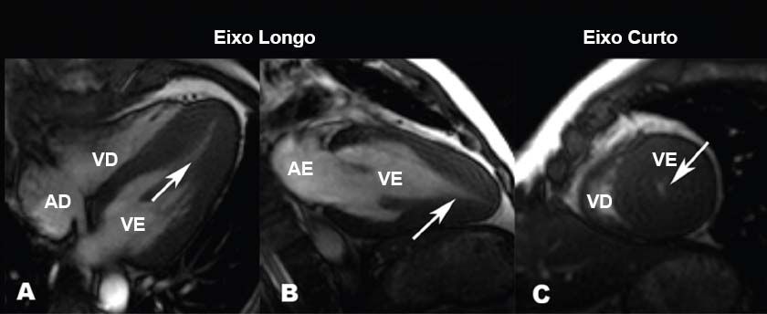 Resultados 33 Figura 5 - Ressonância Magnética retrata imagens em eixo longo e curto de acentuada hipertrofia apical.