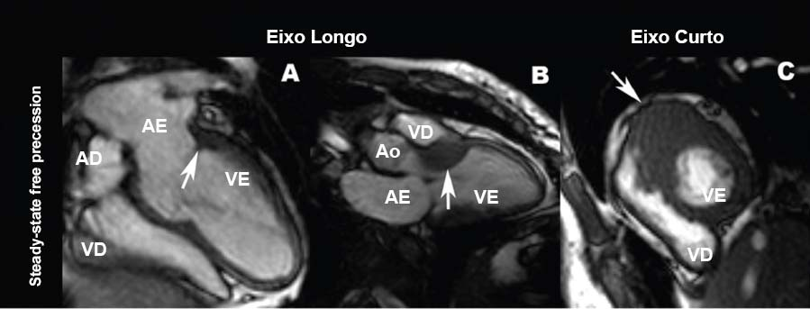Essa forma de cardiomiopatia hipertrófica apical também ficou conhecida como doença de Yamaguchi Figura 6 - Ressonância Magnética retrata imagens em eixo longo e curto de acentuada hipertrofia na