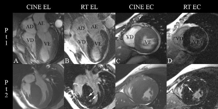 Resultados 39 Figura 11 - Ressonância Magnética de 4 pacientes demonstrando amplo espectro de apresentação entre a hipertrofia e a fibrose miocárdica: Pt 1 (A) Eixo longo (EL) e (C) eixo curto (EC)