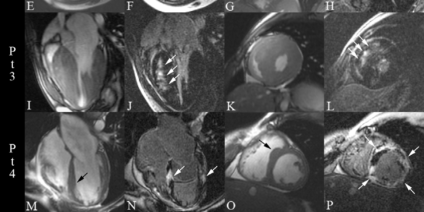 Pt 2 Eixo longo (E) e curto (G) das imagens obtidas em cine retratando acentuada hipertrofia septal de um paciente com CMH com pequenas áreas de fibrose miocárdica pela técnica do realce tardio