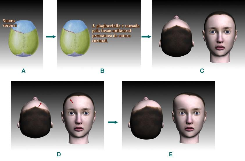 Pôsteres Craniosynostosis development learning object guided by LODPRO Bianca C. Ribeiro, Gustavo B. P. de Freitas, Leandro M. Queiros, Jorge S.