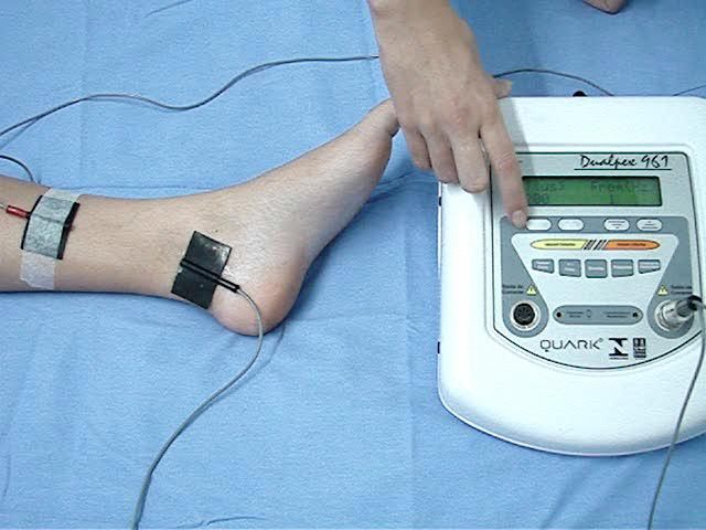 26 Figura 5: Posicionamento do eletrodo agulha para estimulação do nervo tibial Em 2003, Amarenco utilizou eletroestimulação transcutânea do nervo tibial (ETNT) ilustrado na figura 6, em 44 pacientes