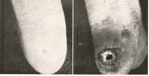 Ao exame radiológico pode-se verificar que a ulcera era o orificio externo de uma fístu1a