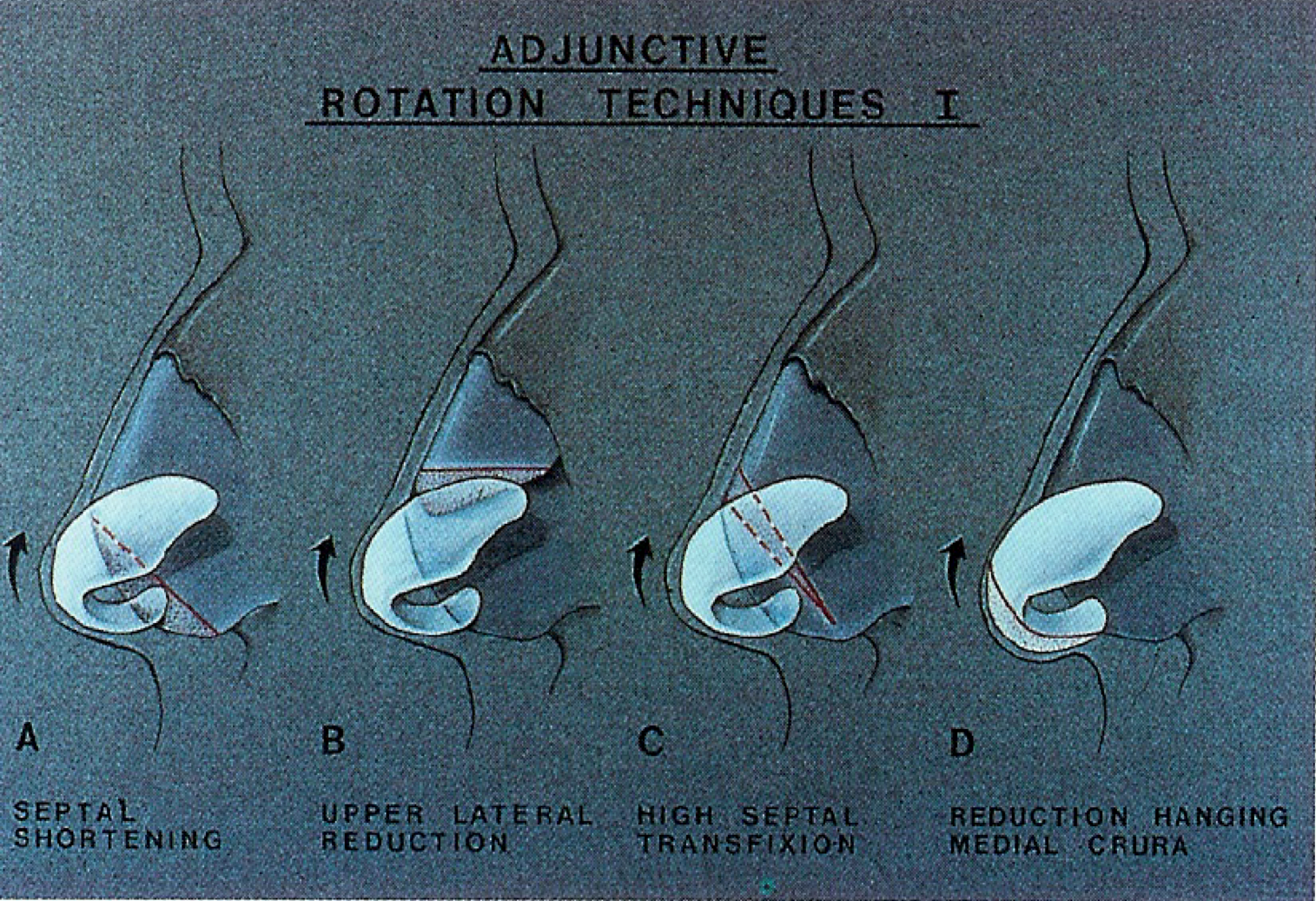 Figura 6 RESSECÇÃO CEFÁLICA CRURAS LATERAIS PROJEÇÃO DA PONTA Depois da rinoplastia primária há um declínio no pós- operatório na projeção nasal, ao menos que