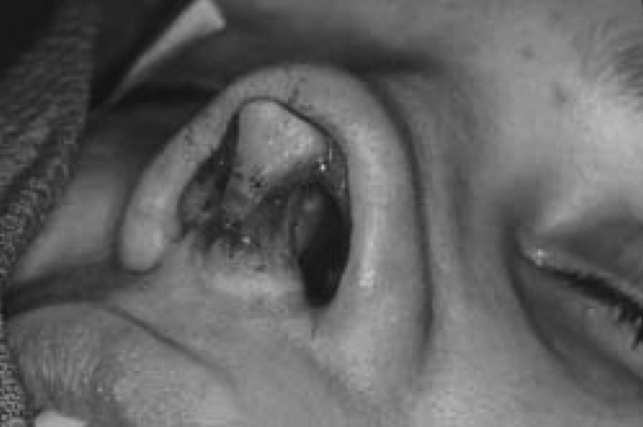 enxerto não deve ser apoiado na espinha nasal, pois um deslocamento da espinha pode causar ao paciente desconforto e assobios. Frequentemente o strut causal pode ser suturado no septo caudal.
