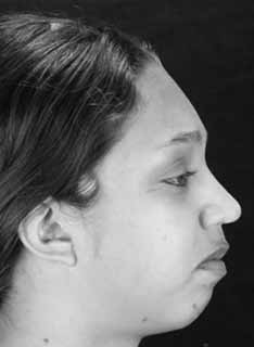 Fotografia pós-operatória do mesmo paciente após o avanço horizontal do mento (C). A As deformidades que afetam o mento foram classificadas por Guyuron et al. 12, que as dividiu em sete classes.