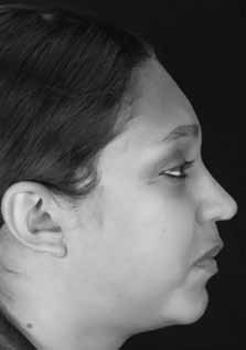 vertical; Classe IV: assimetria do queixo, face curta, face normal e face longa; Classe V: ptose dos tecidos moles associado a macrogenia; Classe VI: pseudomacrogenia - volume ósseo normal associado