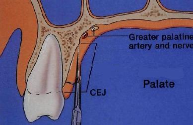 Segundo Studer et al. (1997), a área da raíz palatina do primeiro molar foi considerada a barreira anatômica para se proceder à recolha de enxertos de maior espessura no palato duro.