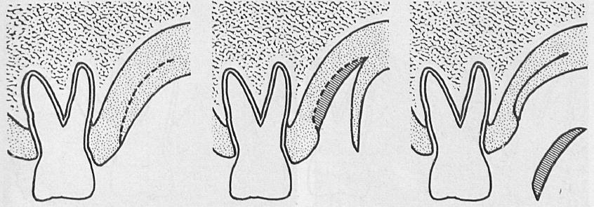 Edel (1974), descreveu pela primeira vez a remoção de enxertos das áreas dadoras, indicando como locais de remoção o palato, a crista alveolar e a tuberosidade: Técnica 1: utilizando o palato como