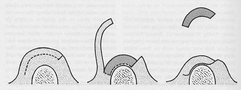 Figura 7: Diagrama de ilustração da técnica 3, na tuberosidade.