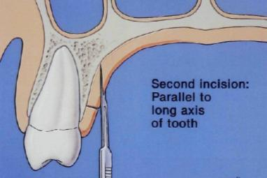 Figura 9: Primeira incisão do local dador realizada de 2 a 3mm apical da margem gengival dos dentes.