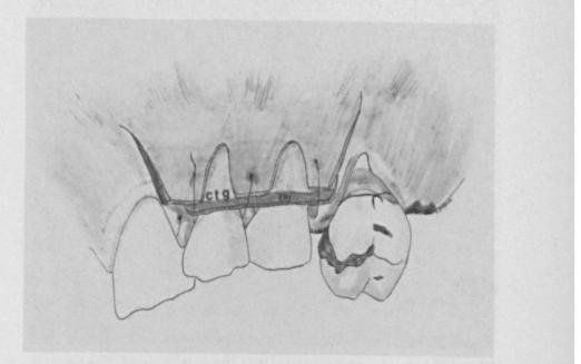 (Langer & Langer, 1985) Figura 16: colocação do enxerto de TC na área recetora. (Adaptado de Langer & Langer, 1985) Figura 17: TC dador e retalho epitelial são suturados na região interproximal.