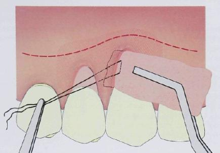 Figura 19: Corte transversal das RG e áreas adjacentes. Elevação suave das papilas, com ajuda de dissecção cortante, adjacentes as convexidades raízes remanescentes.