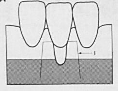 a. Técnica de Nelson Nelson, em 1986, apresentou uma técnica de reconstrução bilaminar, para o tratamento de RG, uma vez que estas são revestidas por duas camadas de tecido, uma de enxerto de TC e