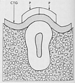 (Adaptado de Nelson, 1986) Figura 31: (CTG) Enxerto de TC; (P) Retalho de dupla papila. A segunda imagem é um corte transversal da primeira.