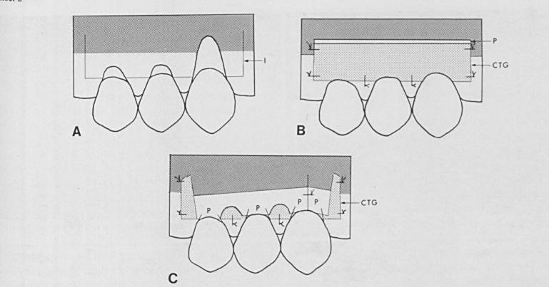 distal das RG (com preservação, quase total, das papilas interdentárias) e uma horizontal sulcular que une as duas verticais.