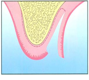 (Scharf & Tarnow, 1992) Figura 33: Crista alveolar edêntula para aumento.