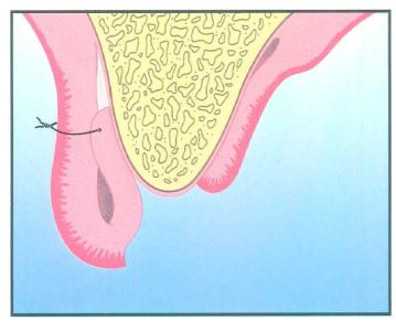 Figura 36: O retalho pediculado é refletido para vestibular expondo o osso alveolar do palato. Um túnel é feito sob o periósteo vestibular para criar um espaço para o tecido dador.