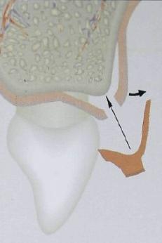 Realiza-se outra incisão em vestibular, ao nível da JCE, da papila que vai ser reconstruída, deixando a papila existente ligada ao retalho palatino. (Azzi et al.