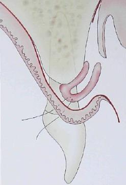 Uma agulha de sutura é introduzida por palatino saindo no espaço interdentário, essa mesma agulha atravessa o enxerto de TC, entra na parte interna do palato, saindo posteriormente, por palatino.