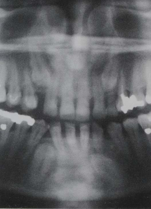feixes de raios X.