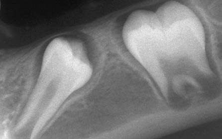 Tracionamento ortodôntico: possíveis consequências nos caninos superiores e dentes adjacentes (Parte 1) pericoronário, temos o aspecto de uma bolsa que continha a coroa dentária e, assim, também é