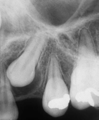 Consolaro A dentina esmalte ER dentina TC A B esmalte FIGURA 3 - O espaço e o folículo pericoronários nos caninos superiores são lateralmente mais bojudos em função da anatomia coronária, como