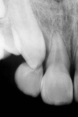 Tracionamento ortodôntico: possíveis consequências nos caninos superiores e dentes adjacentes (Parte 1) FIGURA 5 - Em alguns casos, a reabsorção dentária promovida pelos dentes não irrompidos,
