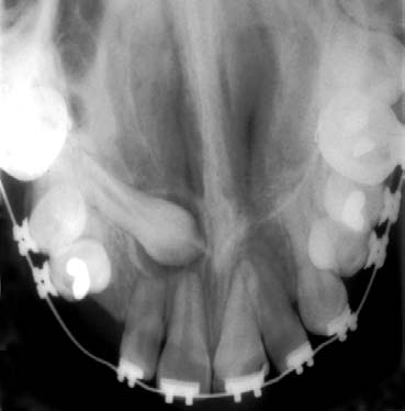 A FIGURA 6 - Independentemente da região dentária relacionada à proximidade do folículo pericoronário do dente não irrompido, pode ocorrer reabsorção radicular desde que ocorra compressão dos vasos