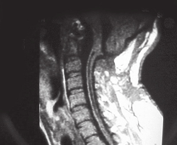 7 possa atingir, sem dificuldade, a margem inferior das tonsilas herniadas.