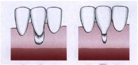 Esta classificação baseia-se em dois critérios: a posição da margem gengival em relação à junção amelocimentária e o nível de tecido periodontal interproximal.