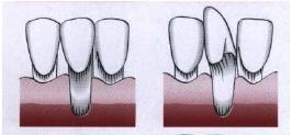 - Grau III Aquela recessão, que se estende até ou para além da linha mucogengival, com perda de inserção na área interdentária ou com mau posicionamento dentário. Fig.