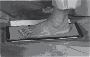148 Beloto, A. B. et al. a prevalência de pés planos em diferentes faixas etárias. METODOLOGIA No que concerne a esta pesquisa, a população foi constituída por habitantes de Maringá - PR.