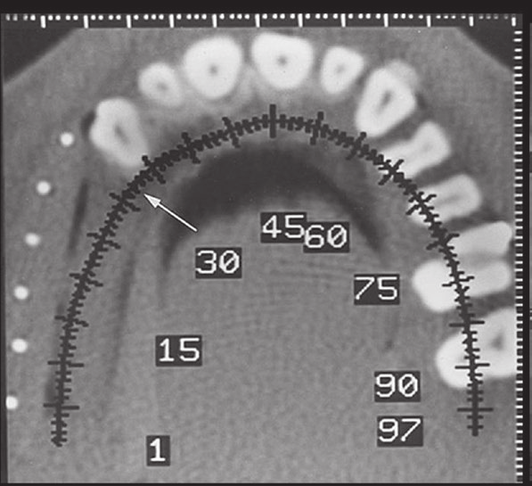 Também pode ser utilizada para avaliação da cortical óssea, no intuito de identificar processos erosivos, cistos subarticulares ou subcondrais, esclerose e osteófitos (Fig. 1.14).