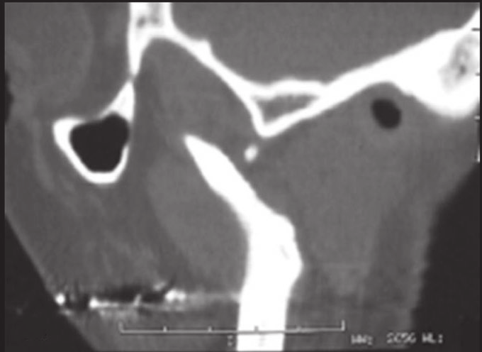 24 Freitas a b Figura 1.16 Imagens de TC. (A) Corte sagital, janela para osso. Observa-se a completa ausência da cabeça da mandíbula esquerda. (B) Reconstrução 3D.
