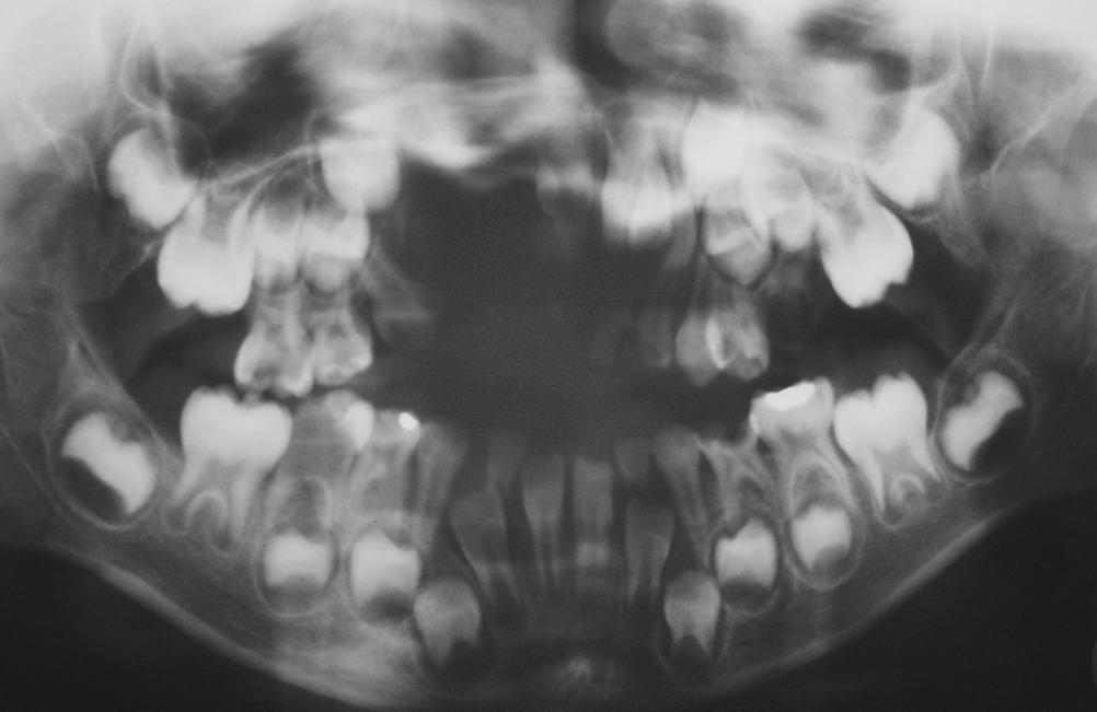 Discussão 67 um caso de recorrência de hiperdontia do incisivo lateral da dentição decídua para a permanente.