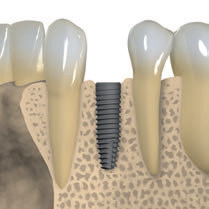 Posição corono-apical do implante Os implantes da Straumann permitem flexibilidade no posicionamento corono-apical do implante, de acordo com a anatomia individual, o local de